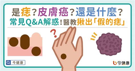 痣長毛|是痣？還是皮膚癌？皮膚科醫師教你揪出「假的痣」，。